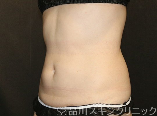 症例NO.72743のAFTER写真