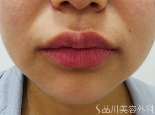 症例NO.72326のAFTER写真