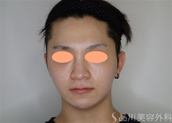 症例NO.51907のAFTER写真