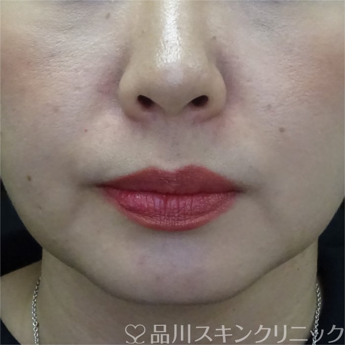 症例NO.69326のBEFORE写真