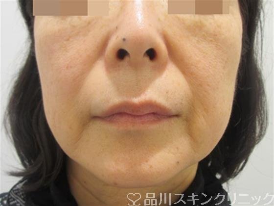症例NO.39031のBEFORE写真
