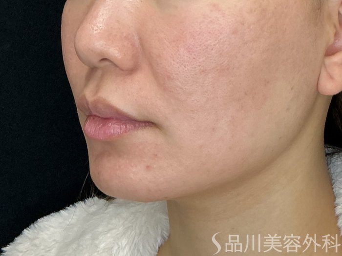 症例NO.72500のBEFORE写真