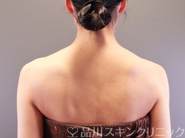 症例NO.64146のAFTER写真