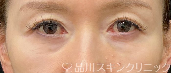 症例NO.75170のBEFORE写真