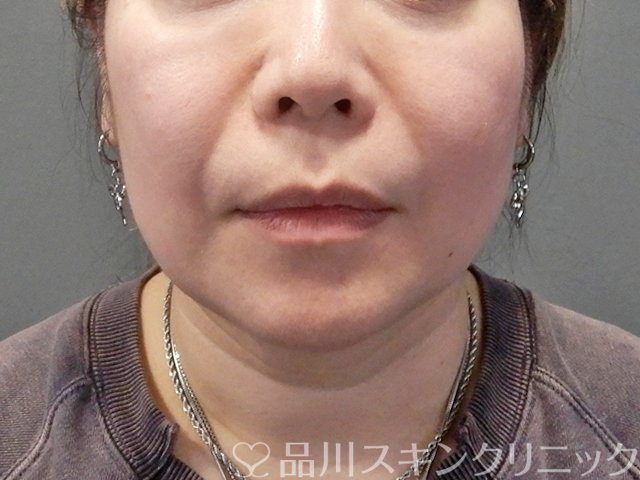 症例NO.69232のBEFORE写真