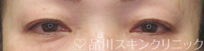 症例NO.70067のBEFORE写真