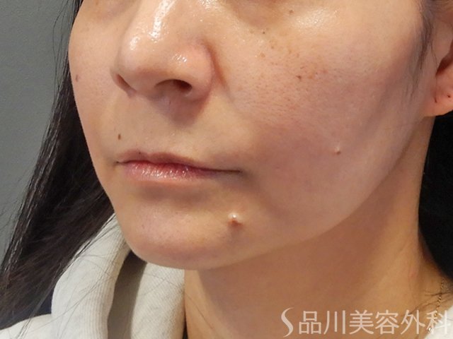 症例NO.73685のBEFORE写真