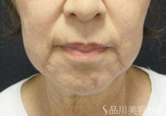症例NO.74975のBEFORE写真