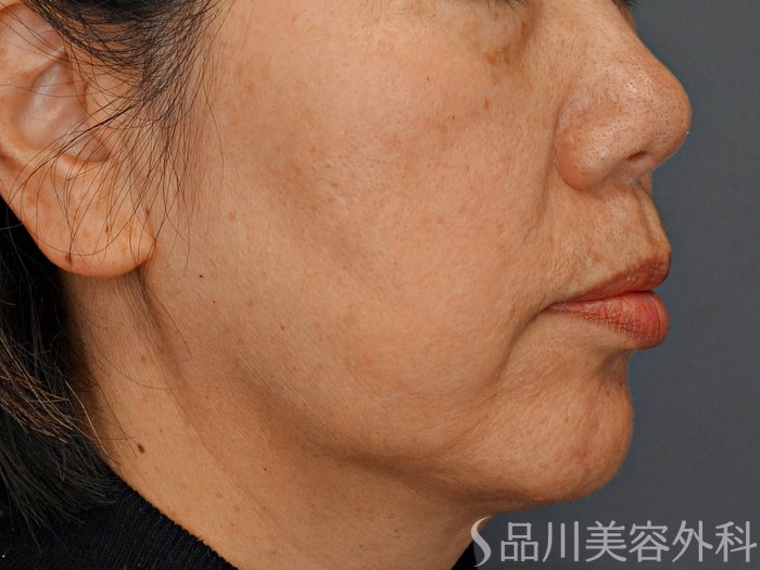 症例NO.73881のBEFORE写真