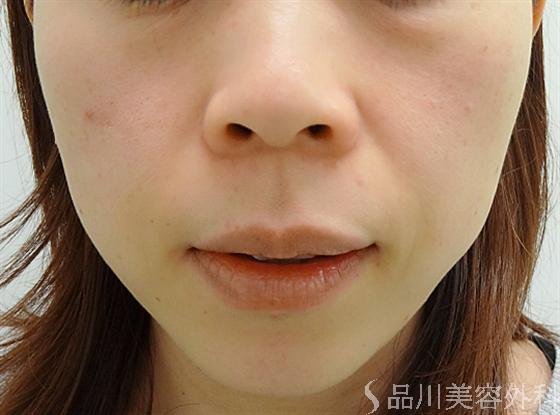 症例NO.13782のAFTER写真