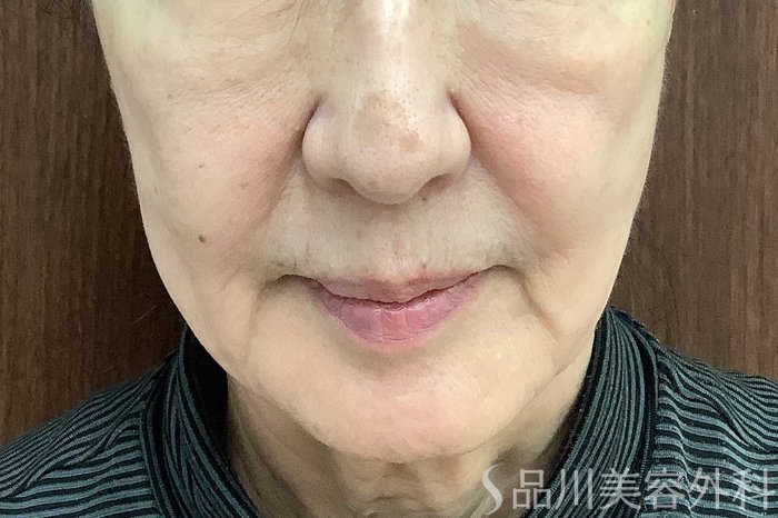 症例NO.62923のBEFORE写真