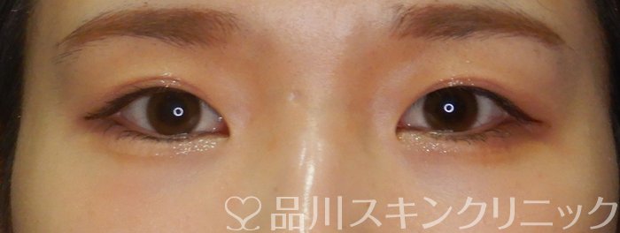 症例NO.63567のAFTER写真