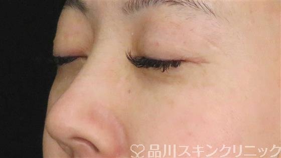 症例NO.61020のAFTER写真