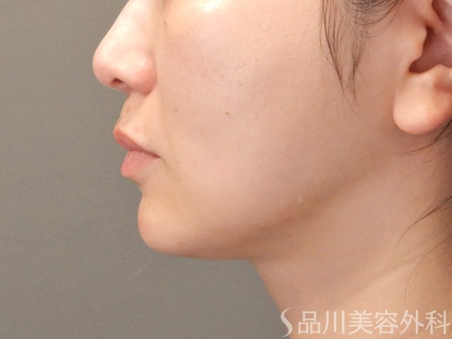 症例NO.74922のAFTER写真