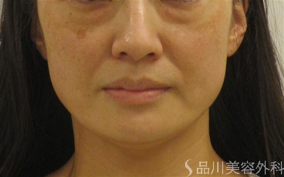 症例NO.59078のBEFORE写真