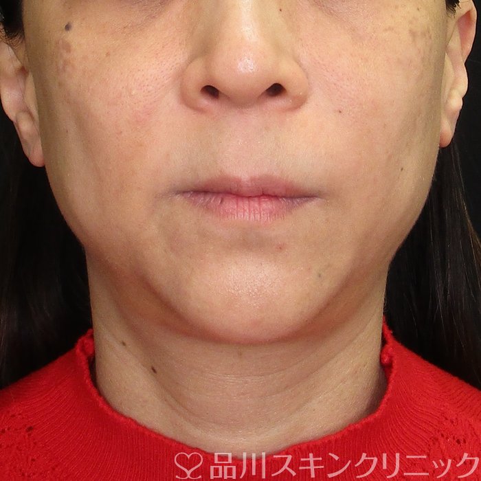 症例NO.70521のBEFORE写真