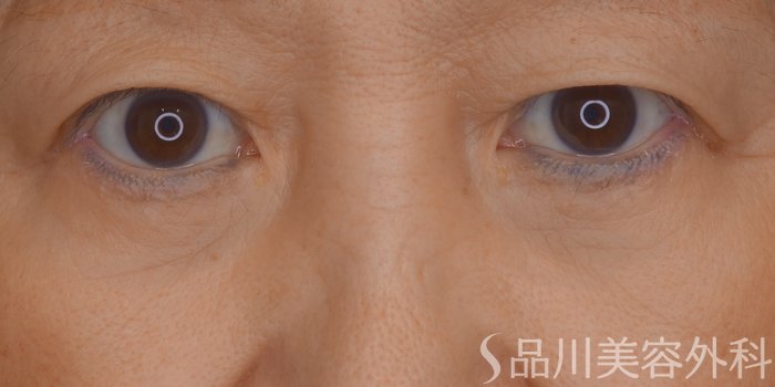 症例NO.69320のAFTER写真