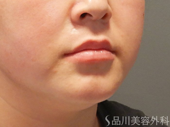 症例NO.68026のAFTER写真