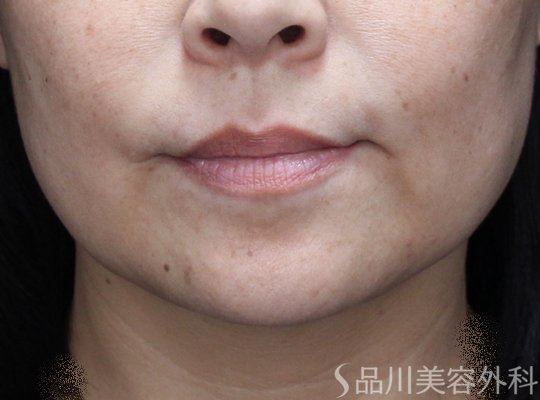 症例NO.71938のBEFORE写真