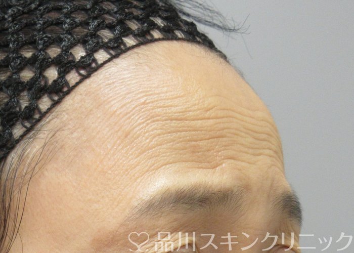 症例NO.72747のBEFORE写真