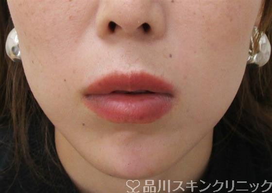 症例NO.37530のAFTER写真