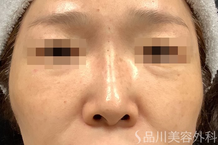 症例NO.71256のAFTER写真