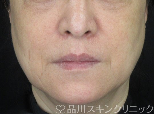 症例NO.69311のAFTER写真