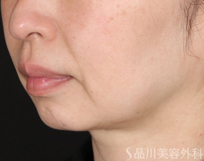 症例NO.73943のBEFORE写真
