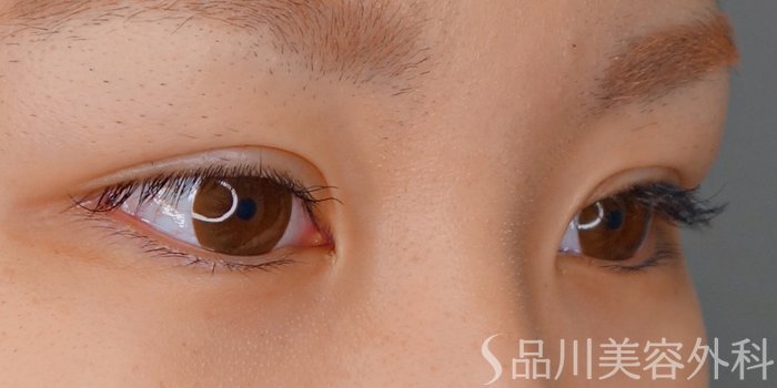 症例NO.68550のAFTER写真
