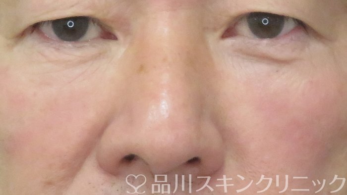 症例NO.71641のAFTER写真