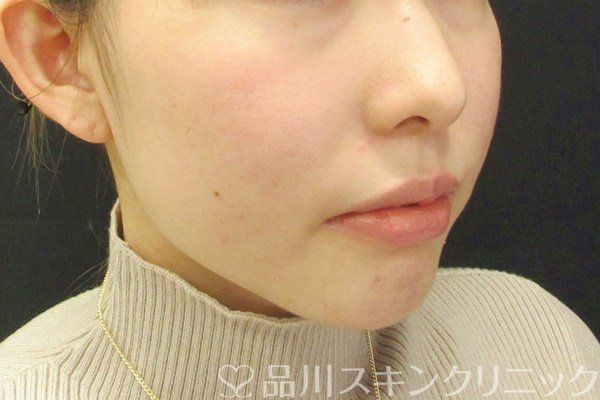 症例NO.68365のBEFORE写真