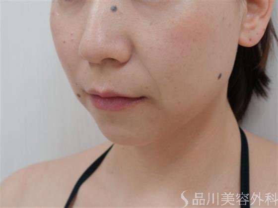 症例NO.33927のAFTER写真