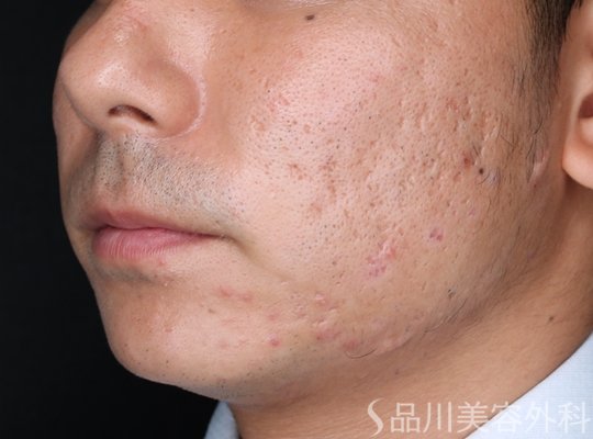 症例NO.72445のBEFORE写真