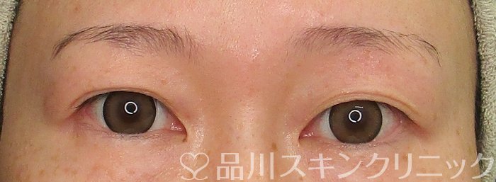 症例NO.70038のBEFORE写真