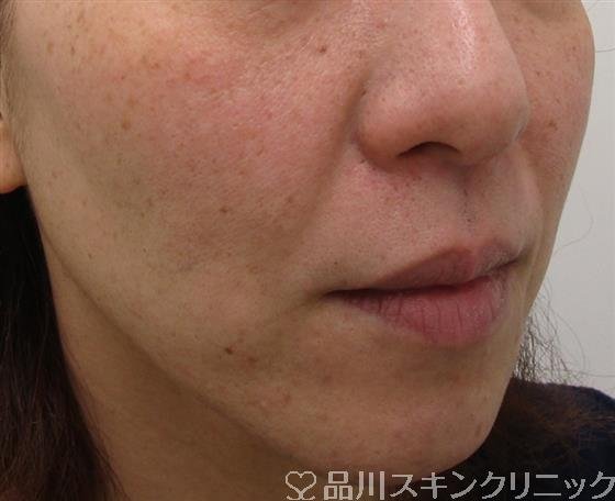症例NO.41444のBEFORE写真