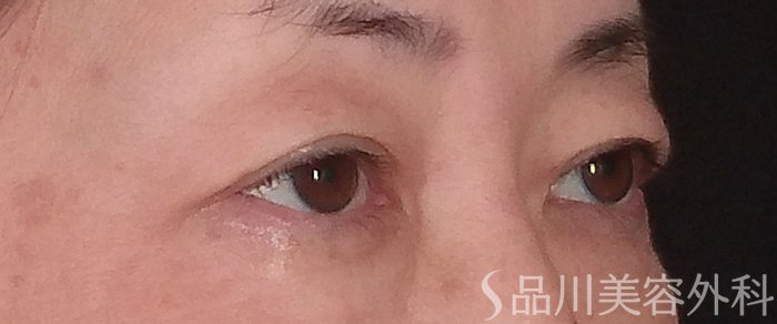 症例NO.70856のBEFORE写真