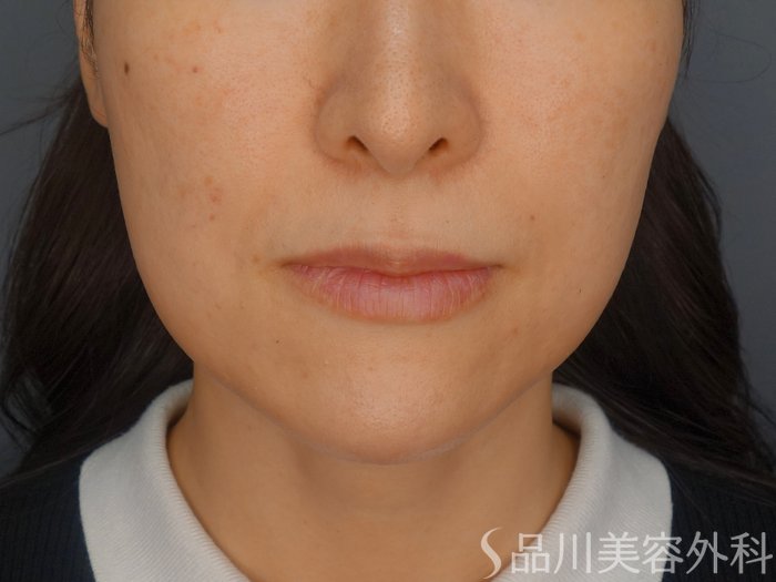 症例NO.72459のBEFORE写真