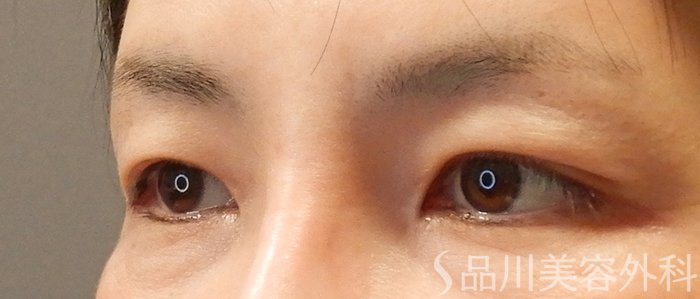 症例NO.69424のBEFORE写真