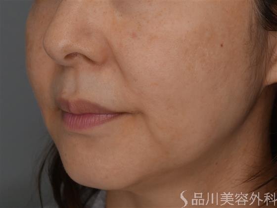 症例NO.52598のBEFORE写真