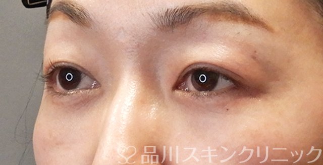 症例NO.68898のAFTER写真