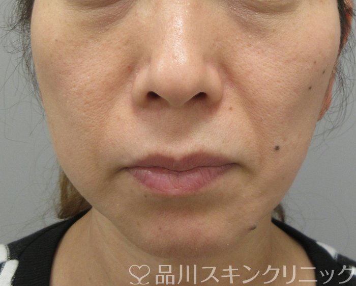 症例NO.74283のBEFORE写真