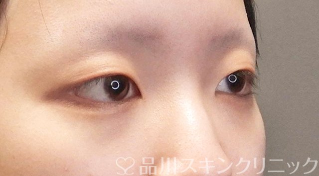 症例NO.66011のBEFORE写真