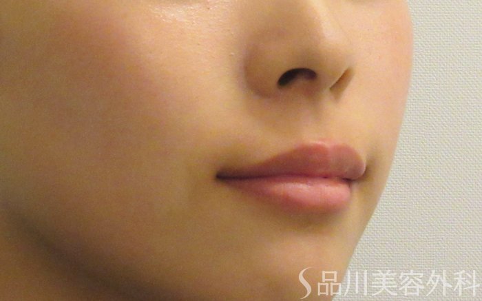 症例NO.74030のAFTER写真