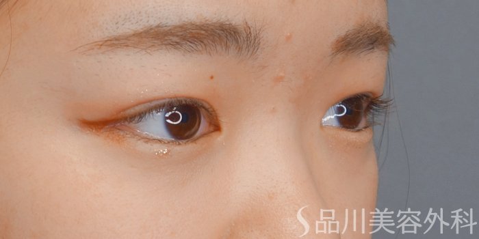 症例NO.73115のAFTER写真