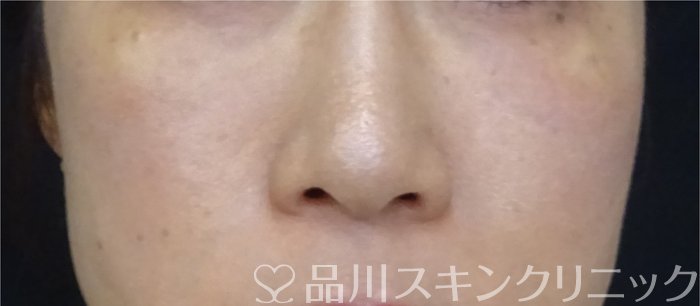症例NO.69903のAFTER写真