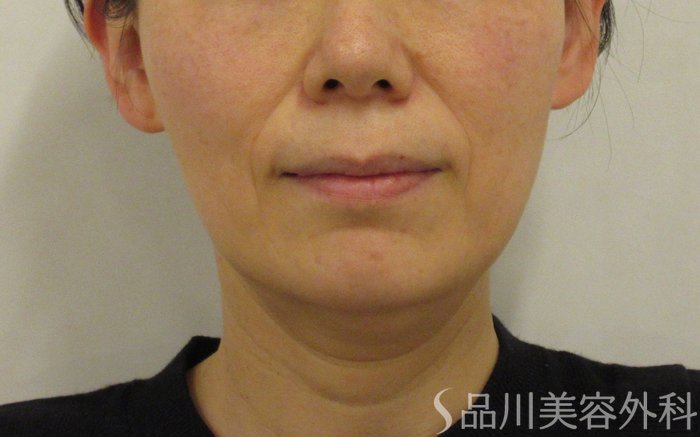 症例NO.73643のBEFORE写真