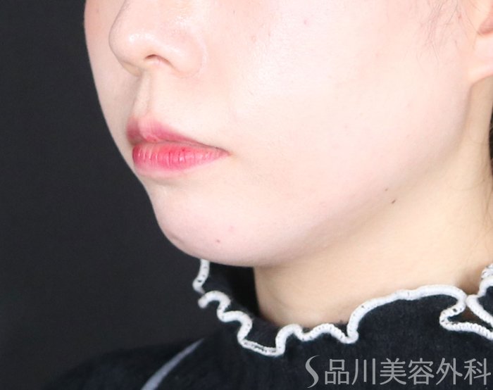 症例NO.72996のBEFORE写真