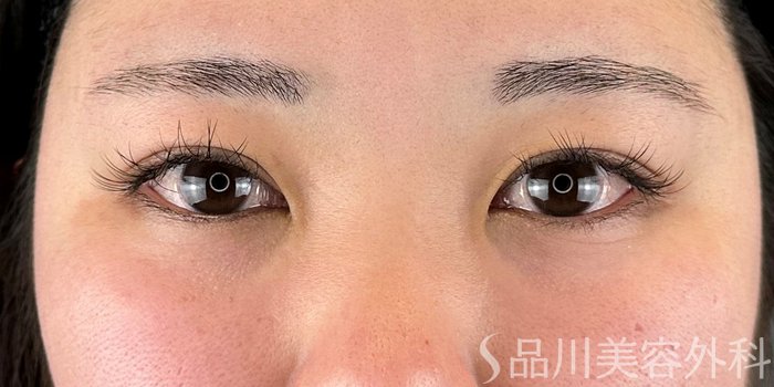 症例NO.70182のBEFORE写真