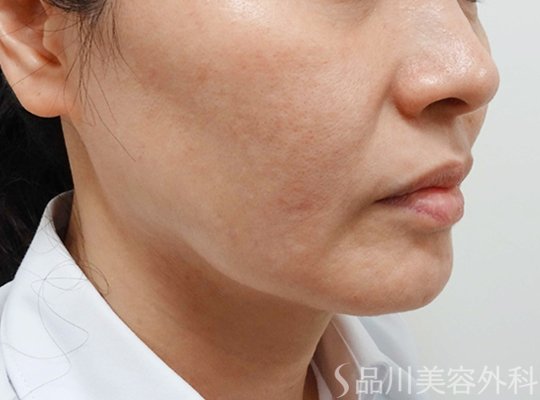 症例NO.67370のBEFORE写真