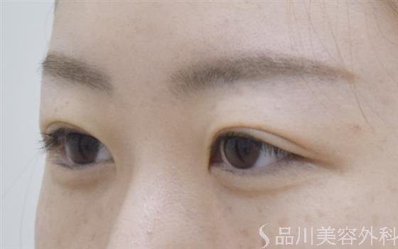 症例NO.54041のAFTER写真